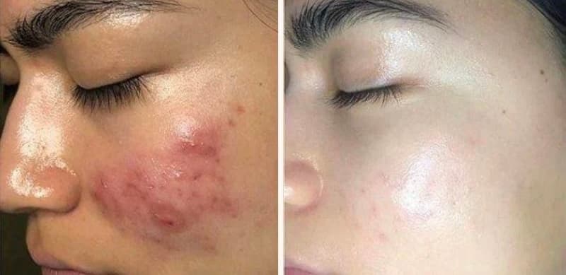 Pimple treatment